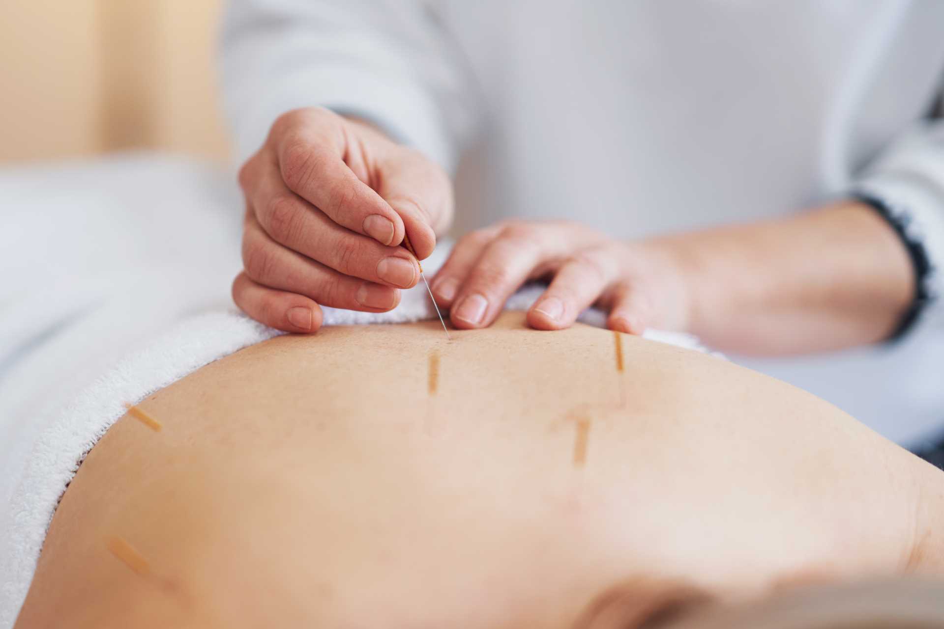 Acupunture needle therapy being conducted on a back | Featured image for the Benefits of Needling Therapy blog from Refine Health Group.