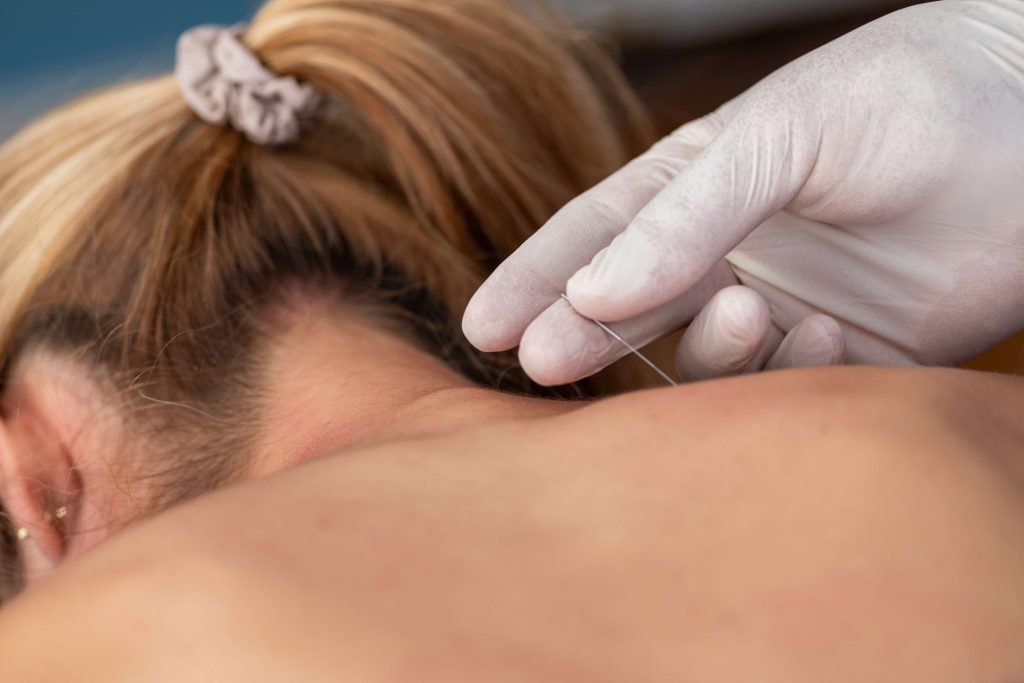 A physical therapist performs dry needling on a patients neck to alleviate muscle tension | Featured Image for the Overcoming Acupuncture Anxierty blog of Refine Health Group